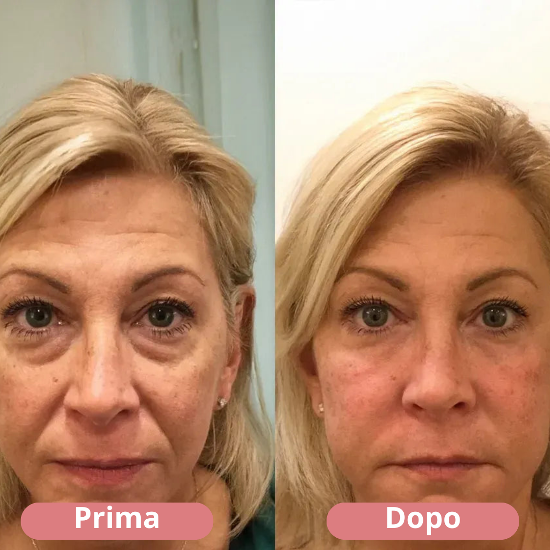 Perfection Eye Tightener