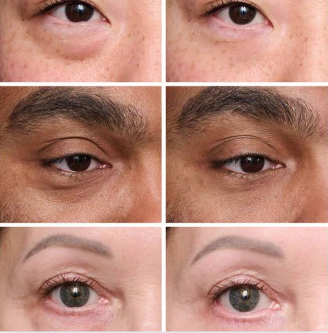 Perfection Eye Tightener